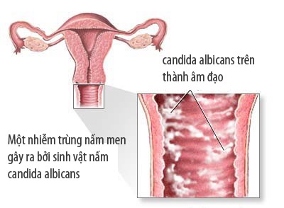 Khi bị nhiễm nấm men, biểu hiện dễ thấy nhất là người nữ sẽ bị chảy máu, thường là sau khi giao hợp, kèm theo các triệu chứng như ngứa rát âm đạo,...